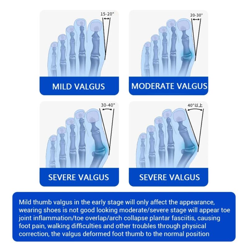 Bunion Corrector Orthopedic - Image 6